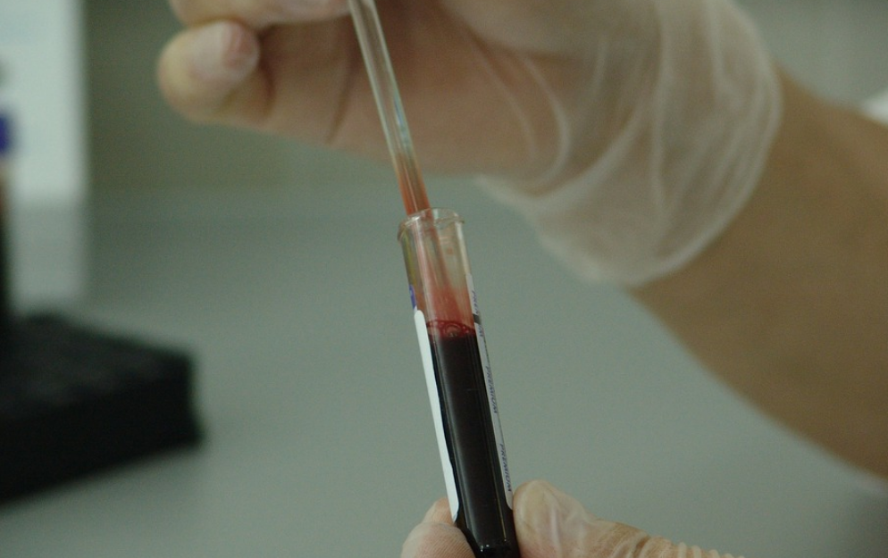 testy krwi pozwolą wykryć 50 rodzajów nowotworów we wczesnym stadium rozwoju